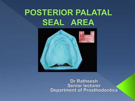 POSTERIOR PALATAL SEAL AREA.pptx