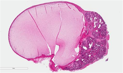 Mucocele Histology