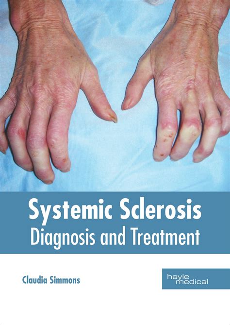 Systemic Sclerosis: Diagnosis and Treatment (Hardcover) - Walmart.com ...