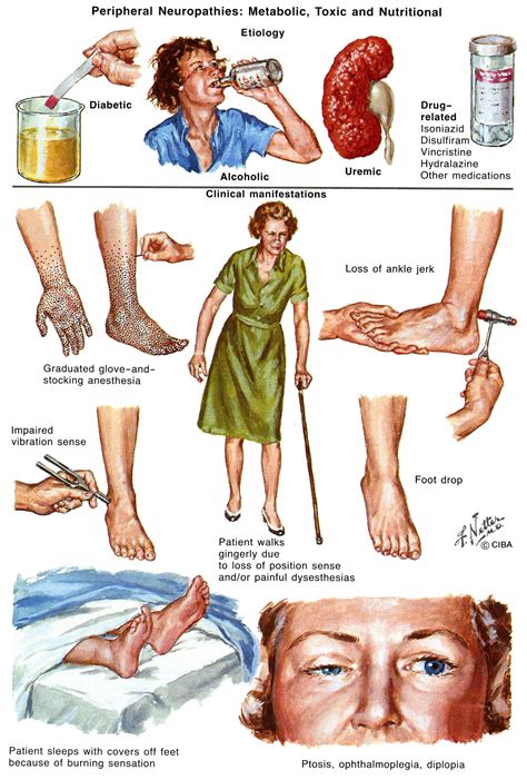 Peripheral Neuropathy. Causes, symptoms, treatment Peripheral Neuropathy