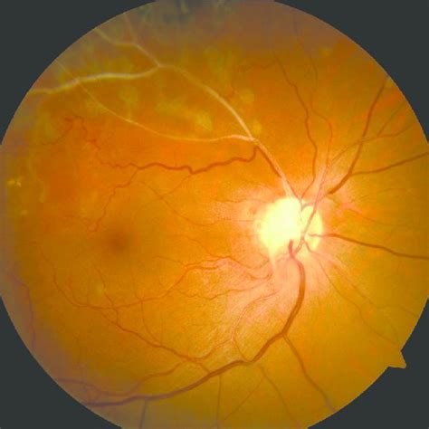 Focal Laser photocoagulation in ischemic peripheral retina in BRVO ...