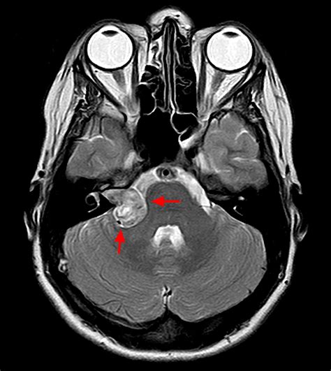 Acoustic Neuroma as related to Brain Tumor - Pictures