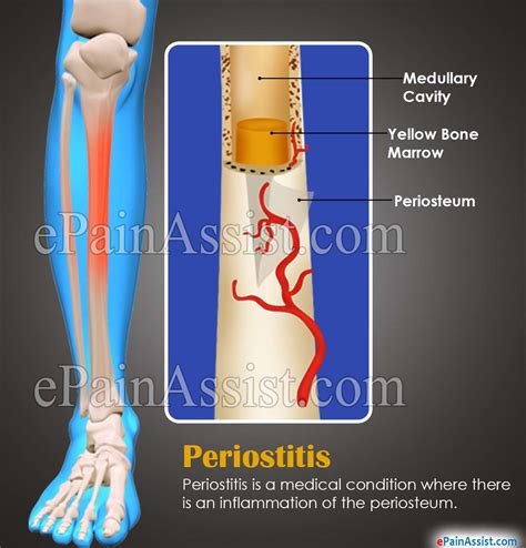 Periostitis - causes, symptoms, treatment - Healthy Food Near Me