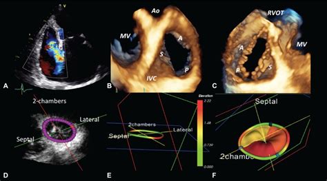 Tricuspid regurgitation echocardiography - wikidoc