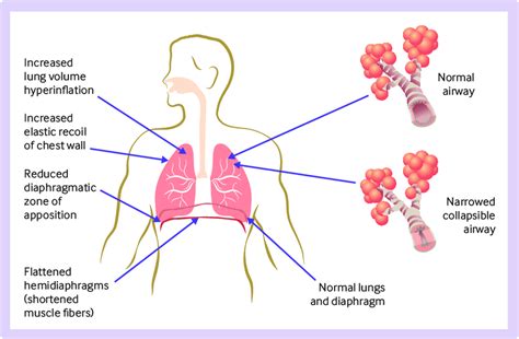 | Pathophysiology of hyperinflation and benefits of non-invasive ...