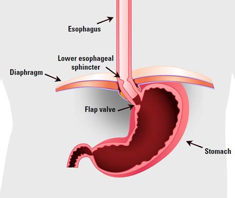 Acid Reflux Symptoms | Bariatric Innovations