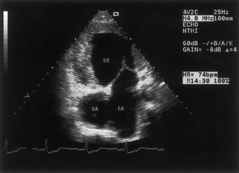 Dramatic Left Atrial and Ventricular Hypertrophy in an Adult With ...