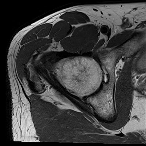 normal hip MRI axial view 3 Diagram | Quizlet