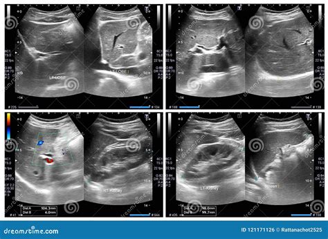 Ultrasound Upper Abdomen Showing Liver, Gall Bladder And Kidney For ...