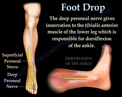 Foot Drop, Peroneal Nerve Injury - Everything You Need To Know - Dr ...