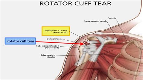 Rotator cuff injury causes, signs, symptoms, diagnosis and treatment