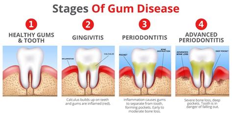 The Stages Of Periodontal Disease - Upper East Side New York, NY: The ...