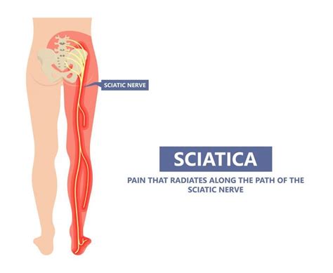 Unlocking the Mystery of Sciatica: Say Goodbye to Nerve Pain!: Remi ...