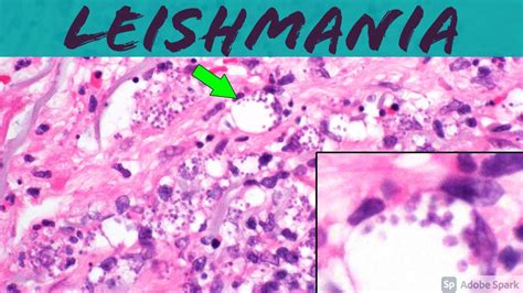 Leishmaniasis (Leishmania Infection) 5-Minute Pathology Pearls ...