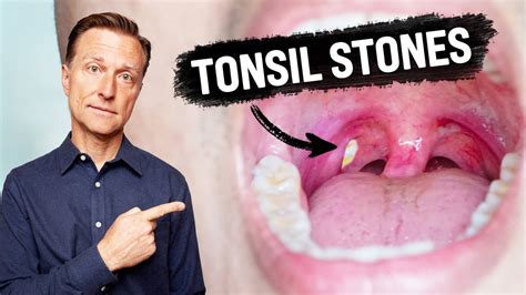 What CAUSES Tonsil Stones and How to Prevent Them| Dr. Berg