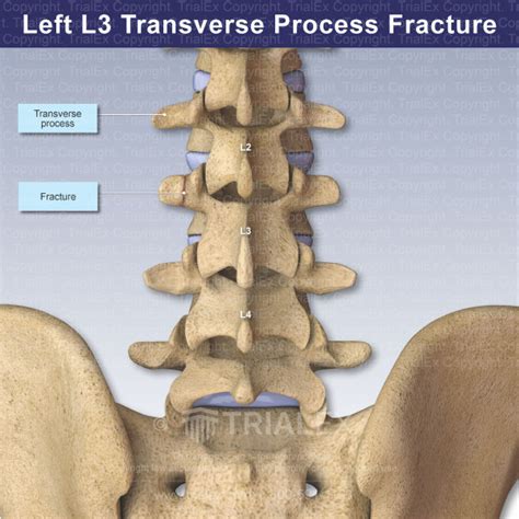 Left L3 Transverse Process Fracture - TrialQuest Inc.