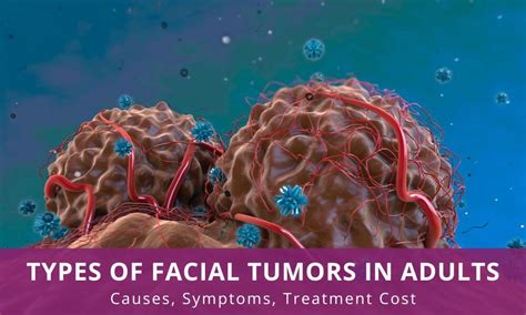 Types of Facial Tumors in Adults | Causes, Symptoms, Treatment Cost ...