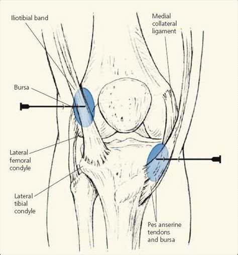 Pes Anserine Bursitis Archives - The Pain Source