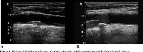 Figure 2 from Ultrasound imaging of carotid atherosclerosis in anormal ...