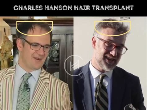 Charles Hanson Hair Transplant - Hair Loss & Technical Analysis