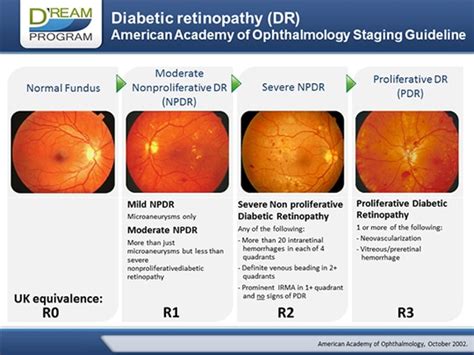 Diabetic Retinopathy Stages