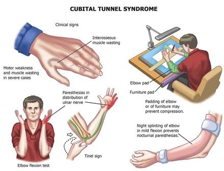 cubital tunnel syndrome-symptoms - New