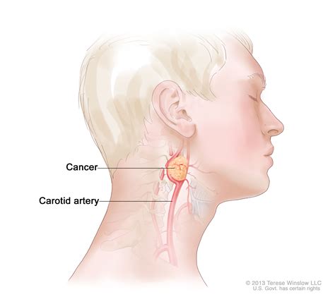 Pheochromocytoma and Paraganglioma – Colorado CyberKnife