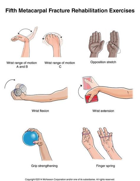 Summit Medical Group - Hand Fracture: Fifth Metacarpal (Boxer's ...