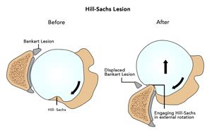 Hill-Sachs Lesion Houston, TX | Shoulder Deformity Houston, TX