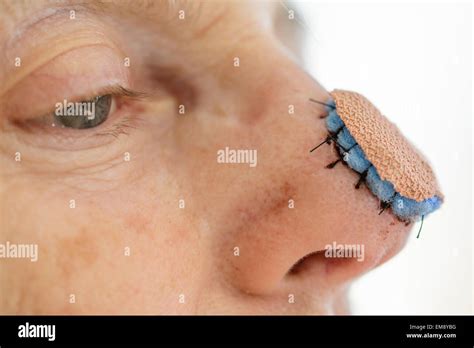 Skin Graft High Resolution Stock Photography and Images - Alamy