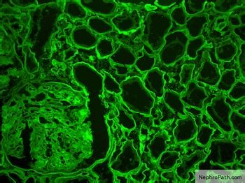 Pathology Outlines - Light chain deposition disease