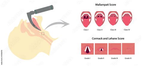 Airway managment illustration.Intubation with laryngoscopy. Mallampati ...