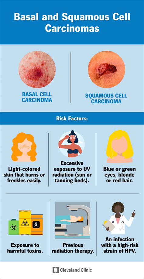 Skin Cancer Types Squamous Cell Carcinoma