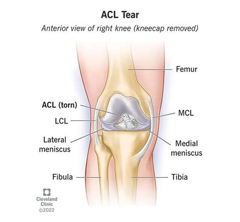 ACL Tear & Injury: Symptoms & Recovery | Acl tear, Acl surgery, Acl knee