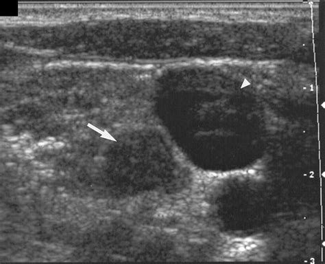 Sonographically Guided Biopsy of Supraclavicular Lymph Nodes: A Simple ...