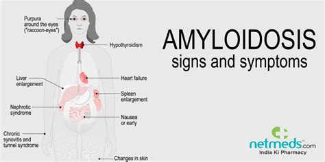 Amyloidosis: Causes, Symptoms And Treatment