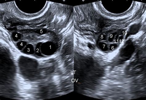 Normal Vs Polycystic Ovaries Ultrasound