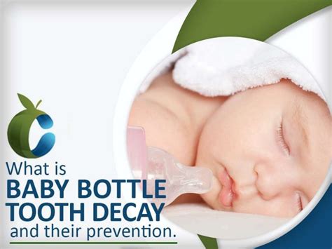 What is Baby Bottle Tooth Decay and their prevention.