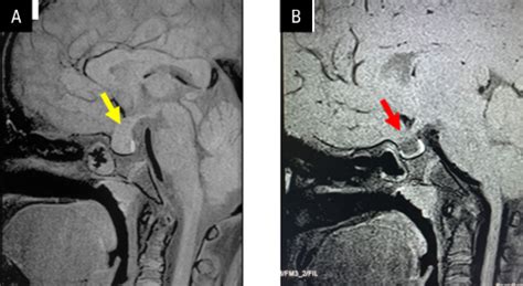 Van Wyk-Grumbach syndrome: a rare presentation of a common endocrine ...