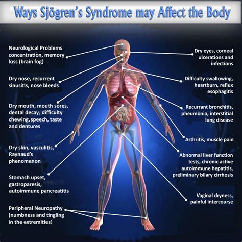 Many Symptoms Of Sjogren's Syndrome Are Neuropathic | Neuropathy and HIV