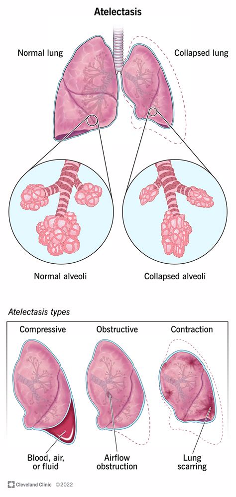 Atelectasis: Causes, Symptoms, Diagnosis & Treatment