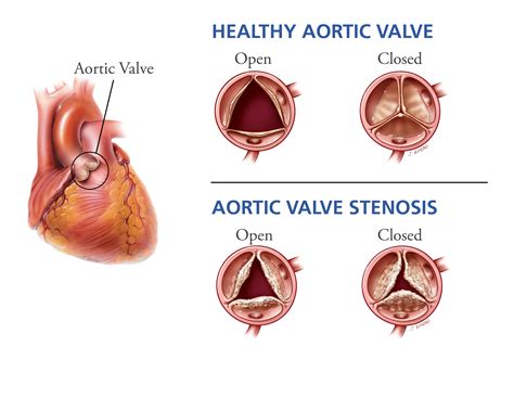 Aortic Valve Stenosis | Heart Care | Intermountain Healthcare