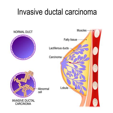 Invasive Breast Cancers | ACS