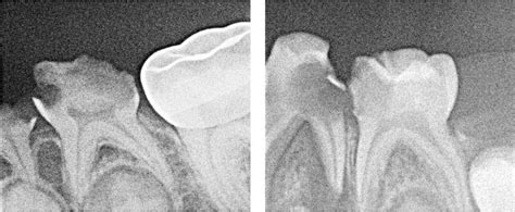 45 Endodontics in the Deciduous Dentition | Pocket Dentistry