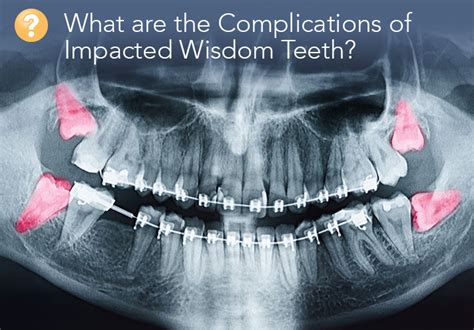 A Guide to the Complications of the Removal of Impacted Wisdom Teeth ...