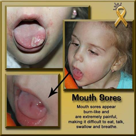 Mouth sores | Childhood cancer awareness, Leukemia awareness, Mouth sores