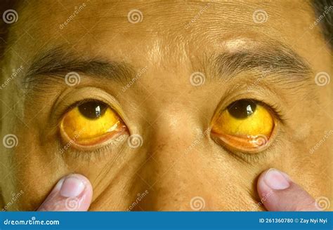 Deep Jaundice In Asian Male Patient. Yellowish Discoloration Of Skin ...