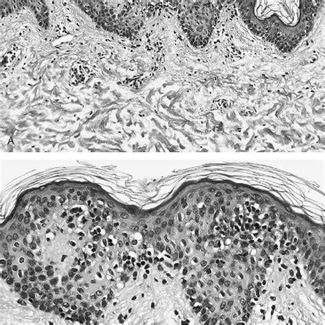 (PDF) ???Hypopigmented Mycosis Fungoides??? Is Not Always Mycosis ...