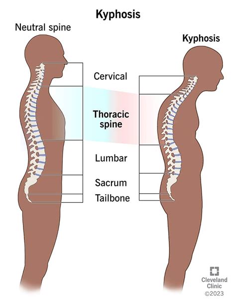 Kyphosis: What It Is, Causes, Symptoms, Types & Treatment