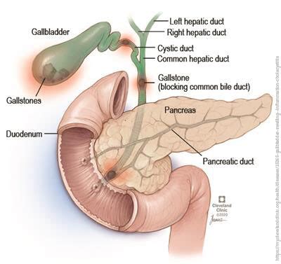 Acute cholecystitis | PaReflectionEd